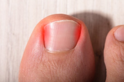 Ingrown Toenail Care