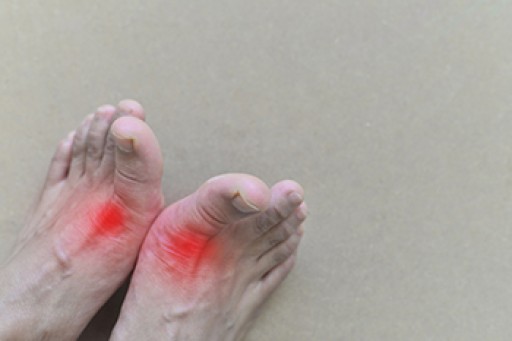 What You Need to Know About Gout