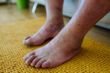Diabetes and Foot Health Awareness