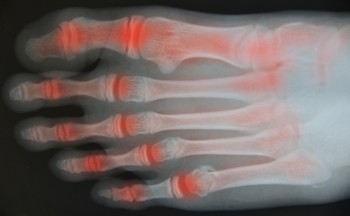 When Arthritis Affects the Feet