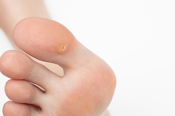 What Are Plantar Warts?