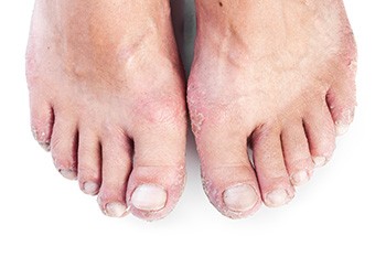 Causes and Treatment of Toenail Psoriasis
